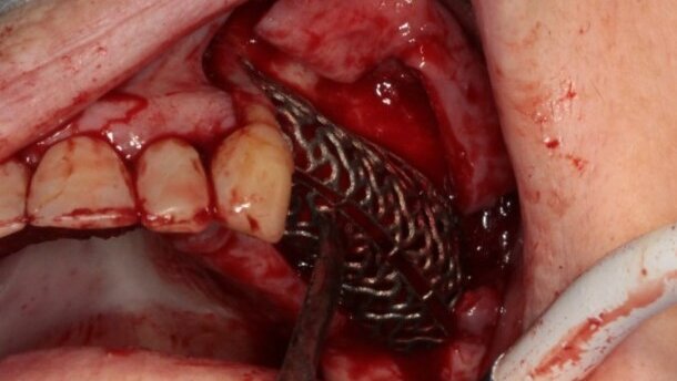 Zastosowanie indywidualnej siatki tytanowej do augmentacji wyrostka zębodołowego szczęki