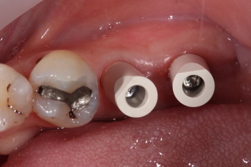Fig. 10: Scanbodies in situ.
