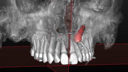 “Impacted canines”: proposta di analisi cefalometrica 3D