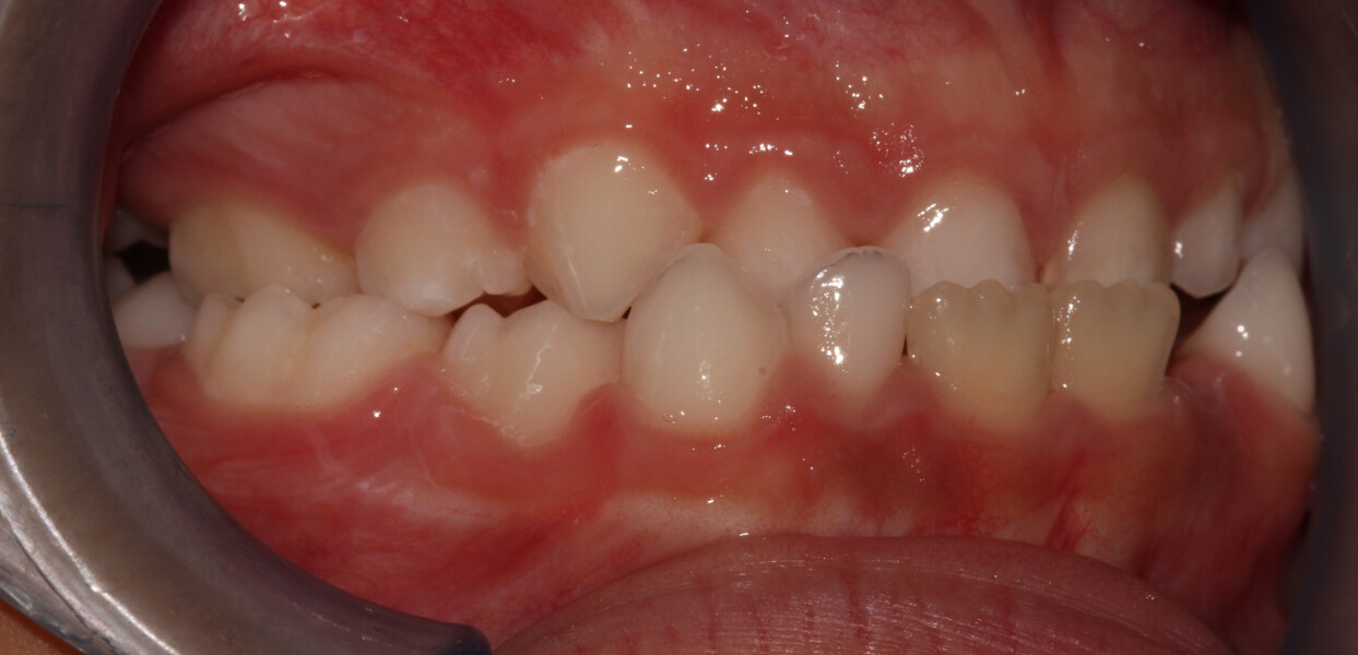 Fig. 6a: Initial intra-oral photographs: right lateral view of the posterior crossbite. 