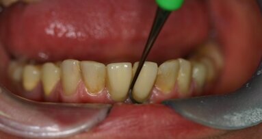 Periimplantitis i mucositis – od diagnozy do leczenia; opisy przypadków