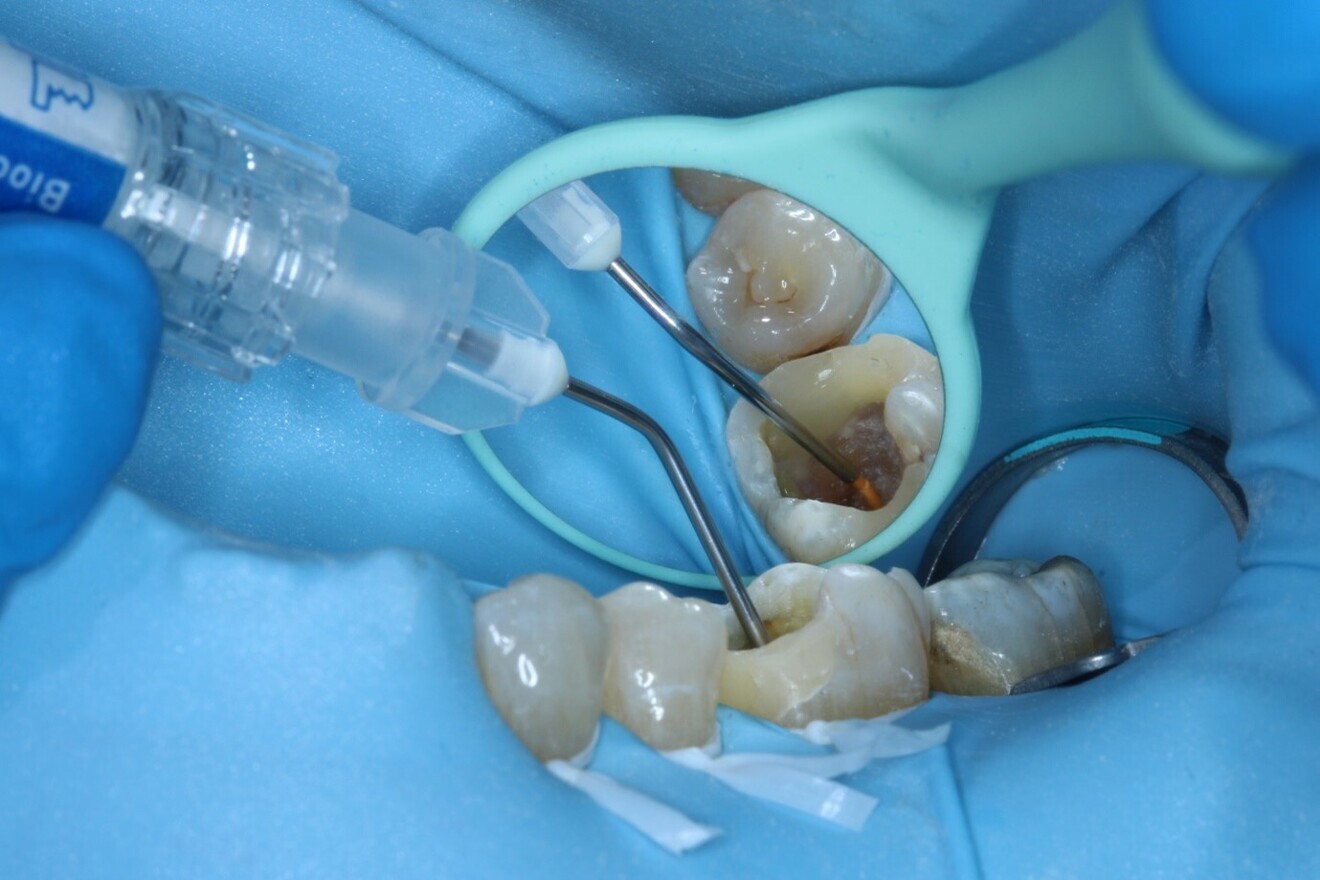 Fig. 11: Using the MST tip to deliver One-Fil bioceramic sealer into the canals.