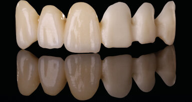 Anatomic Coloured : des blocs teintés dans la masse pour travailler encore plus vite et précisément