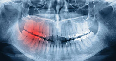 MKG-Chirurgie zwischen Implantologie und Tumorchirurgie