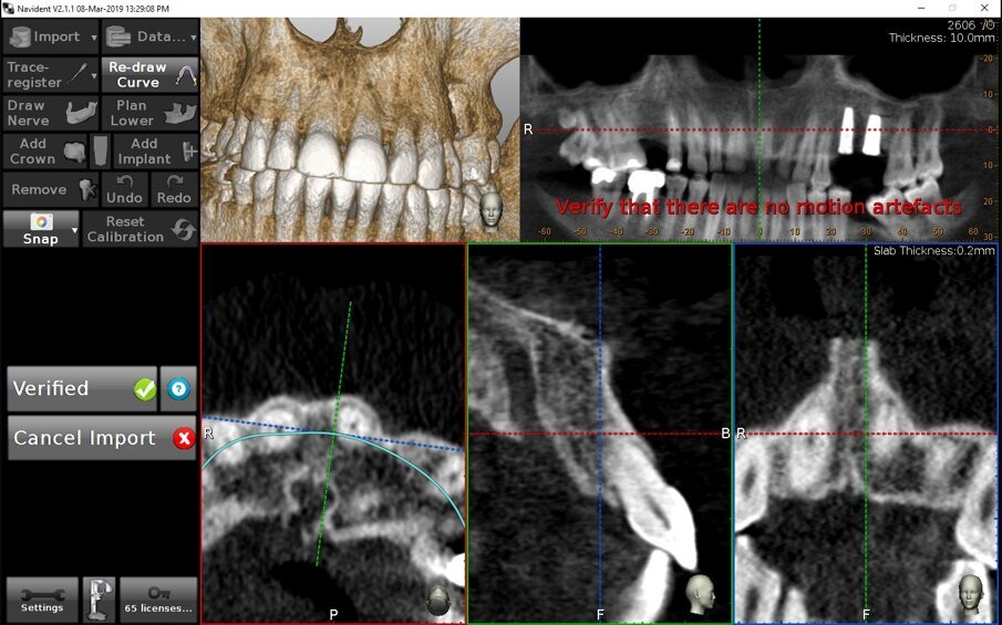 Figg. 8a, 8b - Esempio di assoluto controllo in chirurgia navigata. Fin dalle fasi di acquisizione dei dati il sistema controlla la loro affidabilità. a) Verifica della data della TAC; b) Suggerimento di verifica degli artefatti di movimento.