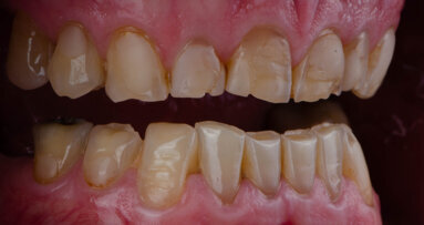 Research provides new insights into how acid damages teeth