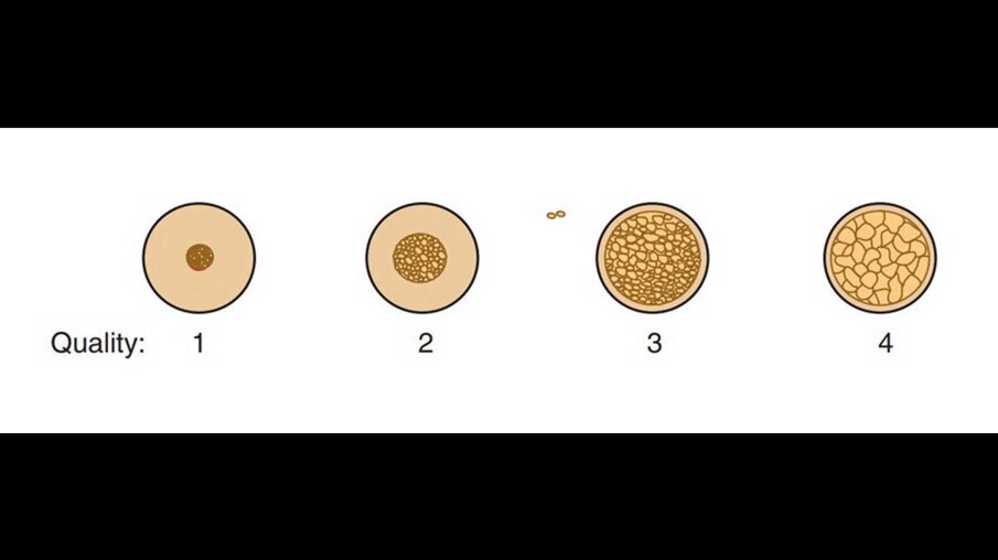 Fig. 2_Classificazione di Misch in base alla struttura dell’osso corticale e trabecolare.