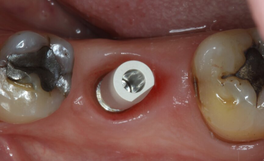 Fig. 22: Scan body in position for digital impression.