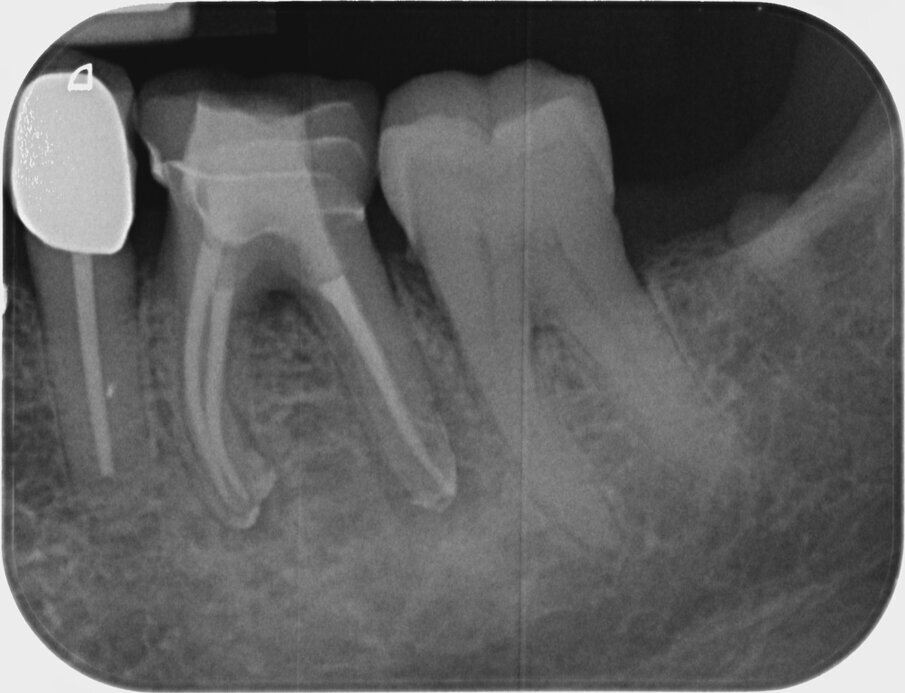 Fig. 16: Radiographic check with cover filling.