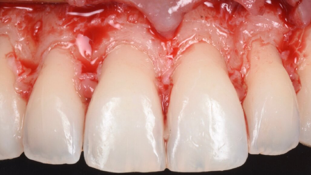 Progettazione della terapia chirurgica dell’eruzione passiva alterata: l’evoluzione digitale