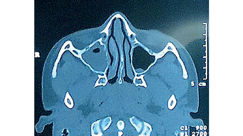 Patologías del seno maxilar