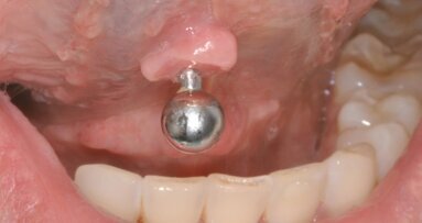 Przerost błony śluzowej języka związany z użytkowaniem kolczyka – opis przypadku