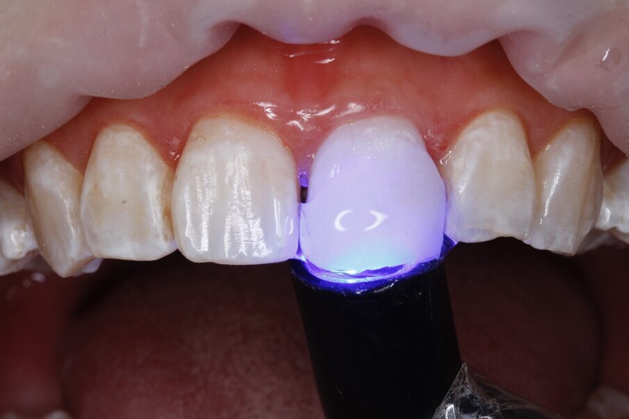 Fig 8: Application of glycerine and final cure
