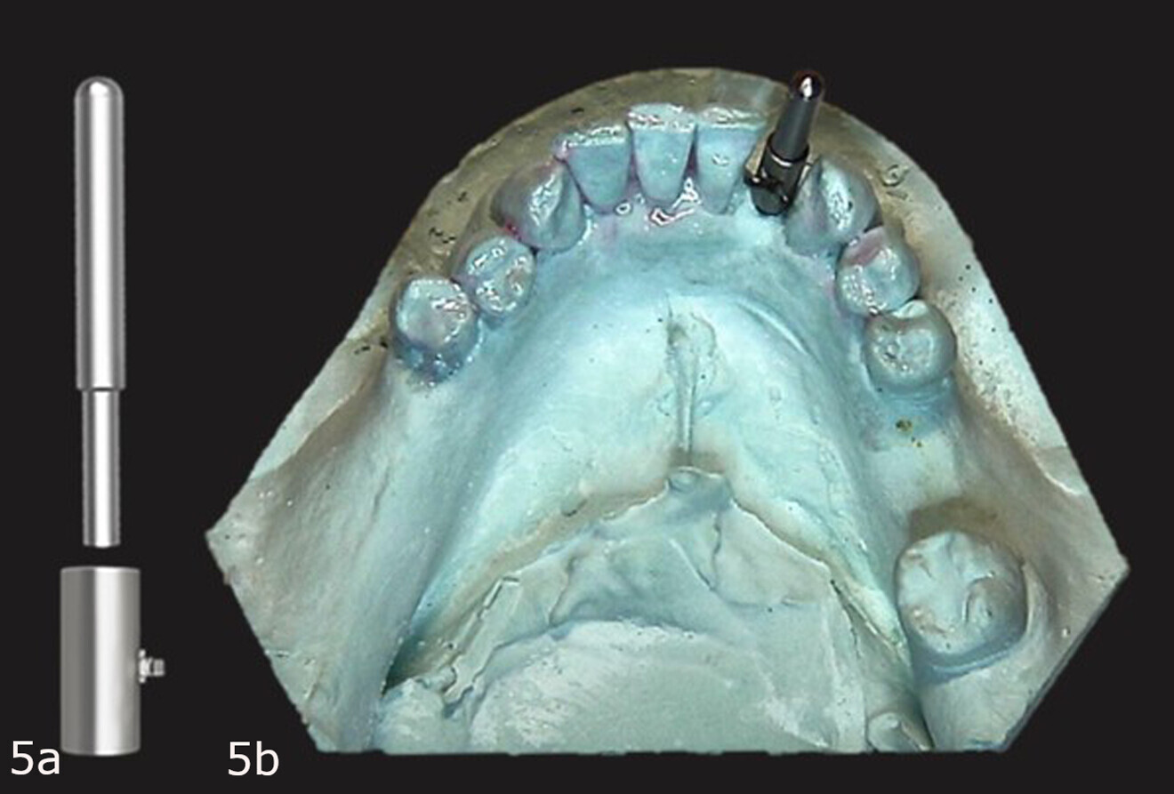 Figs. 5a & b: Guide Right guide sleeve and post (a). Guide sleeve placed over the guide post with the retentive cleat positioned on the lingual aspect (b).