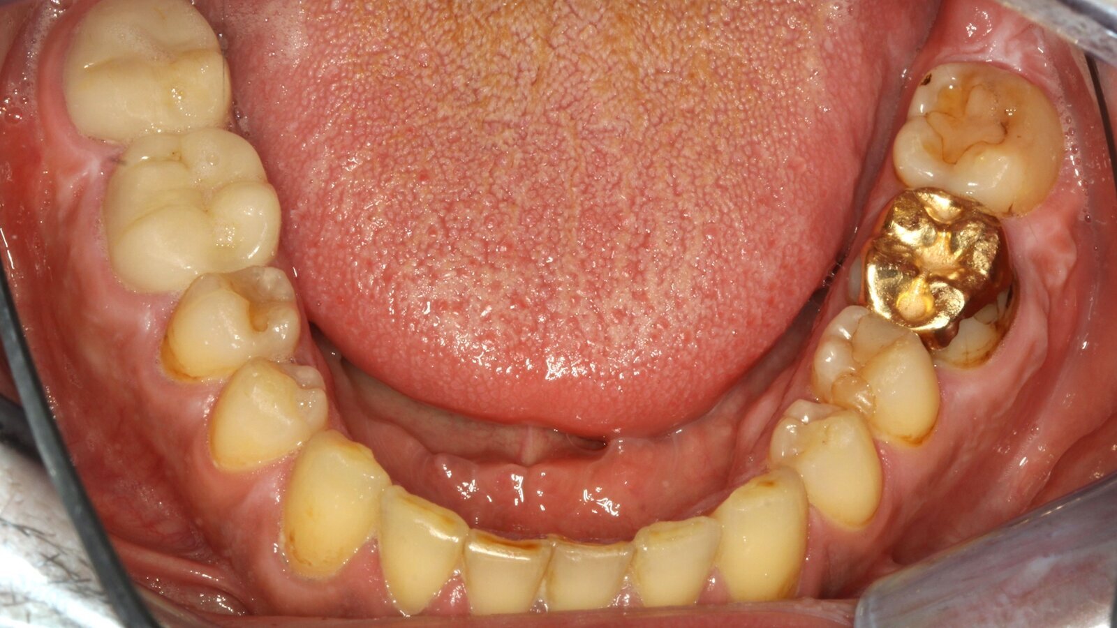 Tratamiento de paciente con endocarditis y caries activas
