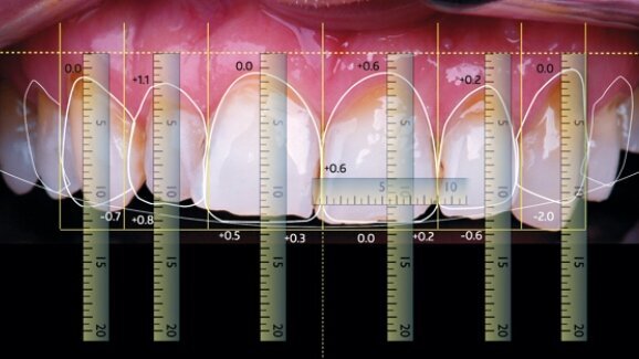 Cyfrowe projektowanie uśmiechu, przeniesienie projektu na model roboczy – część 2