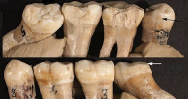 Hallan signos de odontología prehistórica en el Hombre de Neandertal