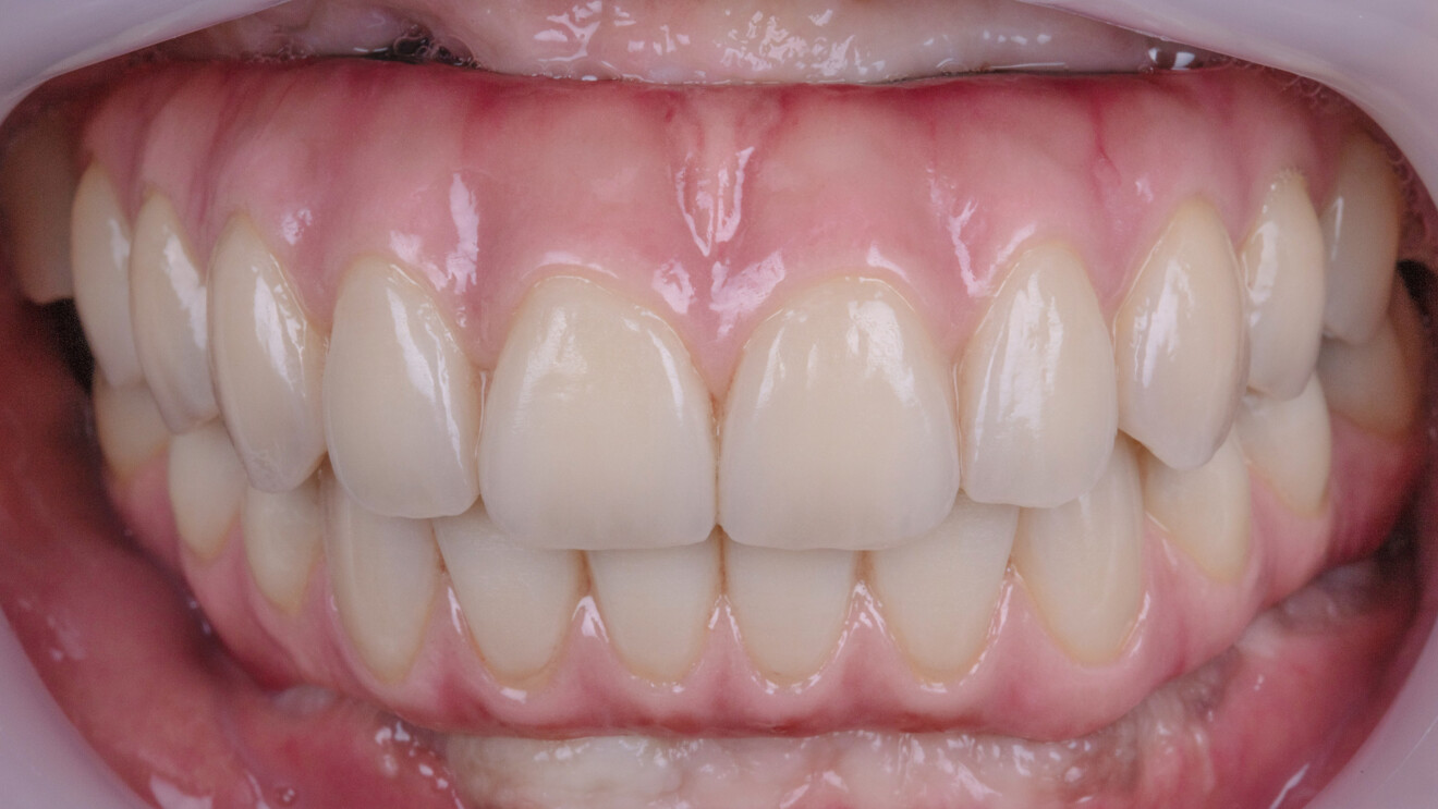 Fig. 18b: Definitive screw-retained, porcelain-veneered maxillary and mandibular full-arch prostheses in occlusion after delivery.