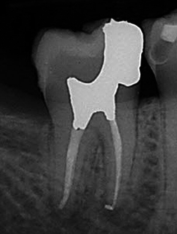 Fig. 8 : Cette conception de cavité d’accès restaurée relevait de l’opportunisme au meilleur sens du terme. La pathologie endodontique de ce patient a été traitée pratiquement sans aucune élimination de structure dentaire. L’intégrité structurale de la dent a été préservée grâce à l’utilisation de la lésion carieuse nettoyée comme cavité d’accès. Aucun besoin d’une couronne de recouvrement total. (Photo : fournie par le Dr Michael Trudeau)