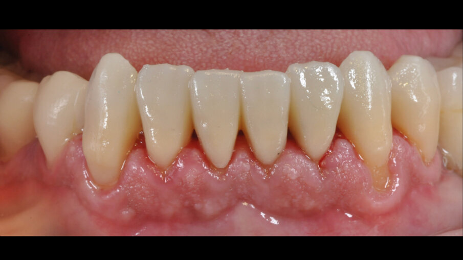 Fig. 6_Restauro cementato nel cavo orale.