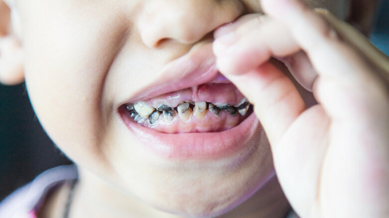 Duration of breastfeeding may impact dental caries