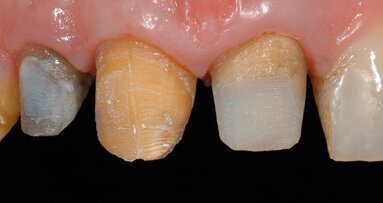 Riabilitazione protesica in area ad alta valenza estetica tra tecniche tradizionali e digitali