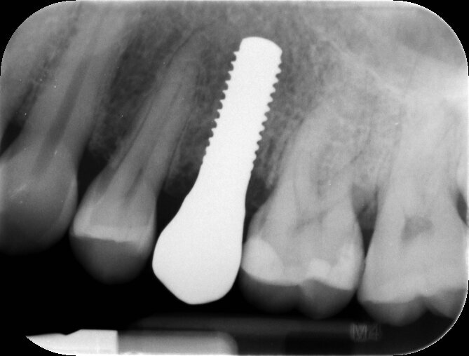 Fig. 18_A distanza di 1 anno dal carico si esegue un controllo radiografico endorale con centratore dedicato per valutare una sovrapposizione degli esami futuri che seguiranno nel follow-up la paziente.