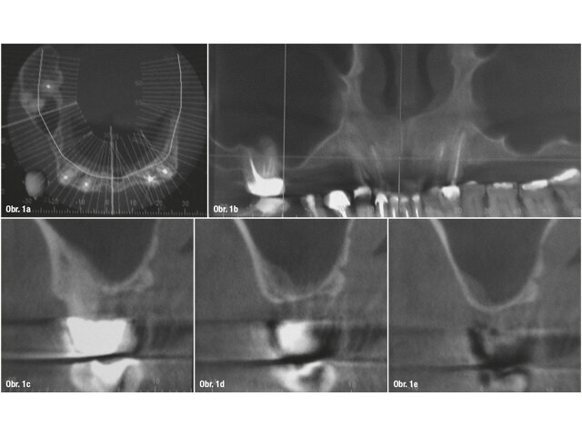 Preoperační CT analýza: a) koronální řez zachycující omezenou nabídku vertikální kosti a b) panoramatický pohled na horní čelist se zjevným nedostatkem vertikální reziduální kosti v prvním kvadrantu. c–e) Sagitální řez v oblasti zubu 16 s vertikální nabídkou kosti menší než 1 mm.