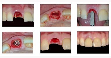 Immediate Implant Placement with Socket Shield Technique followed by Chairside Provisionalisation