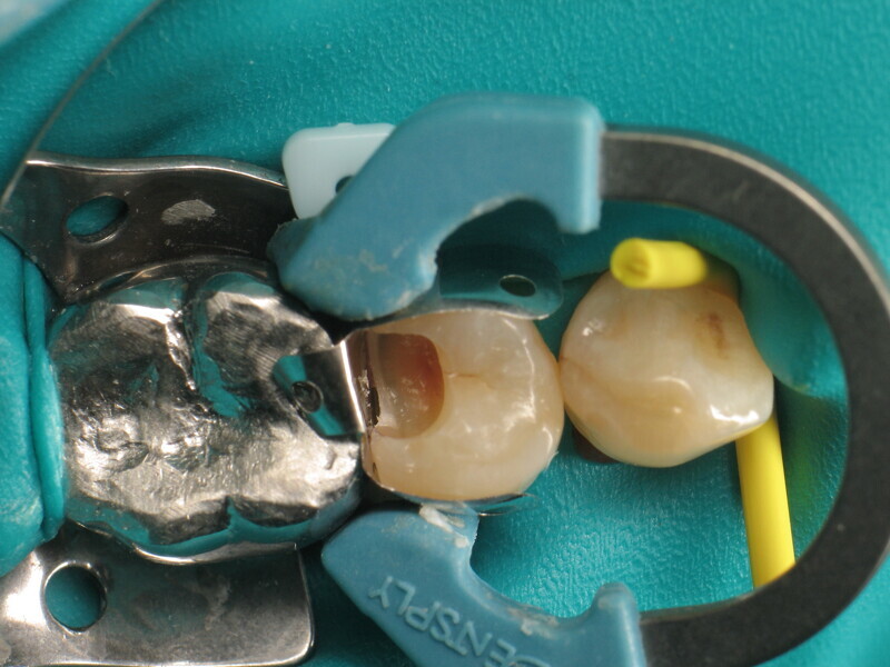 Fig. 4 : Installation de la matrice proximale.