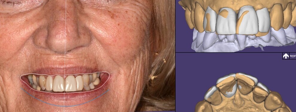 Fig. 12: 2D, 3D and 4D imaging combined in DentalCAD 3.1 Rijeka (exocad).
