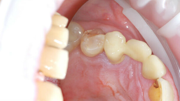 Ceramica ibrida per sollevatori di pesi