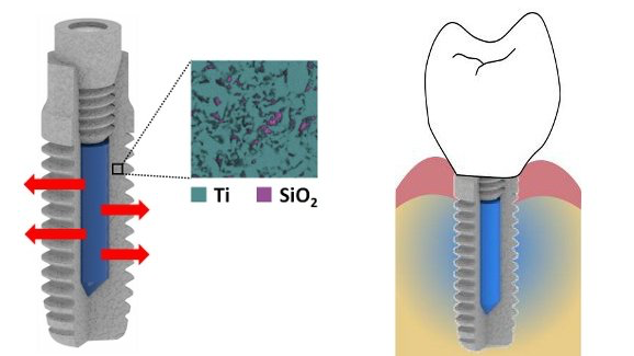 Un implante que libera fármacos antimicrobianos