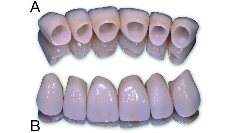 FujiCEM Evolve, un ciment verre ionomère modifié par adjonction de résine