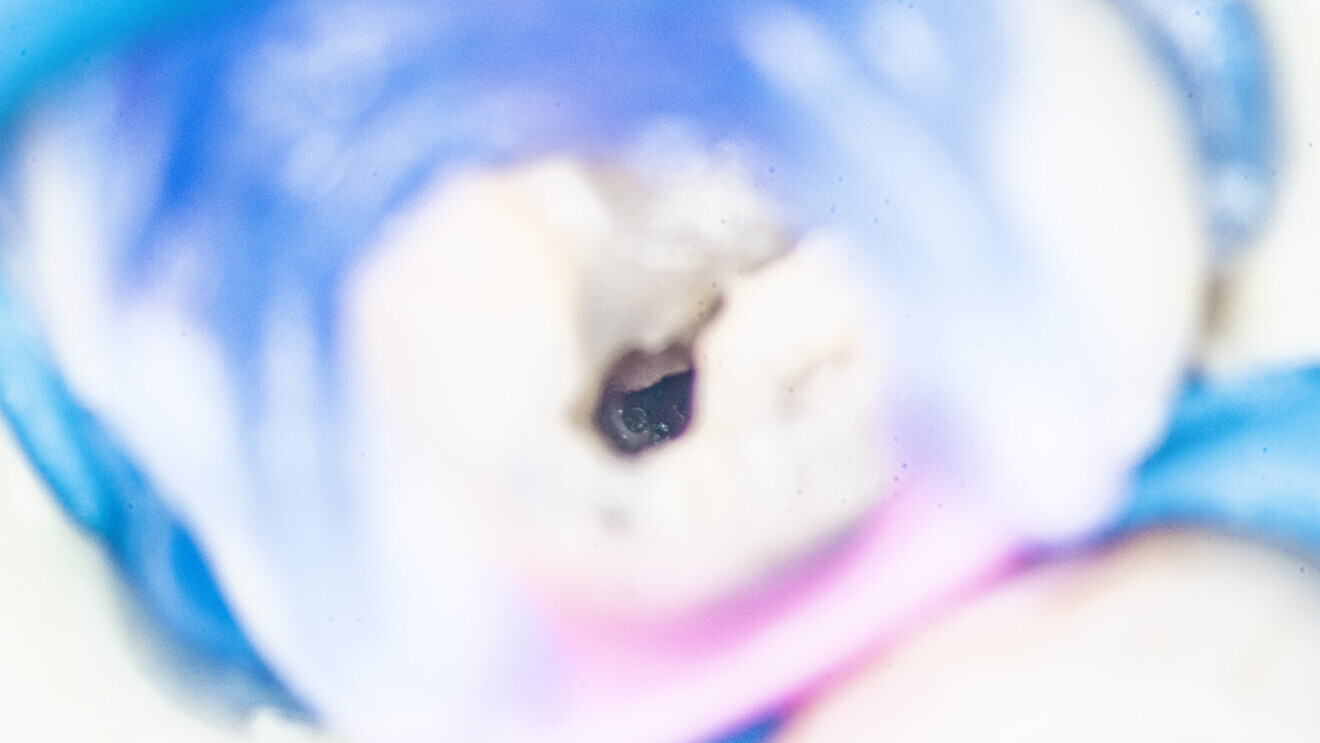 Fig. 33: View of the two broken files together in the mesiobuccal canal.