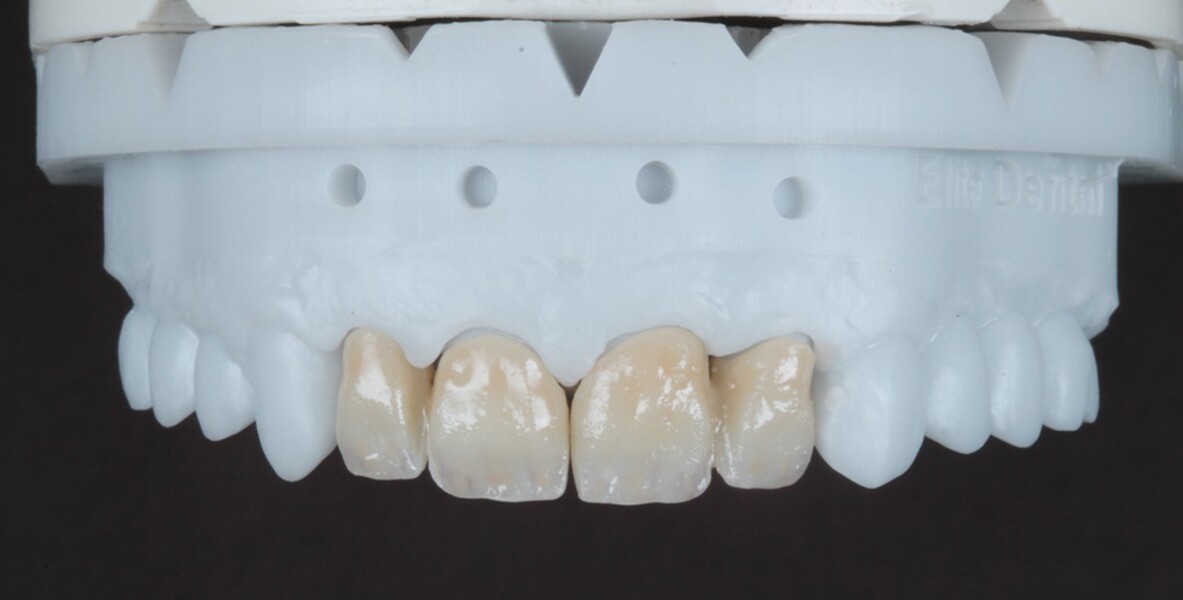 Fig. 7: Restorations on the model after internal staining, achieving specific characteristics for a natural depth effect. 