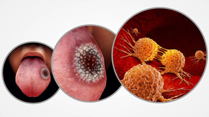 “20 años de Avances en Cáncer Oral”