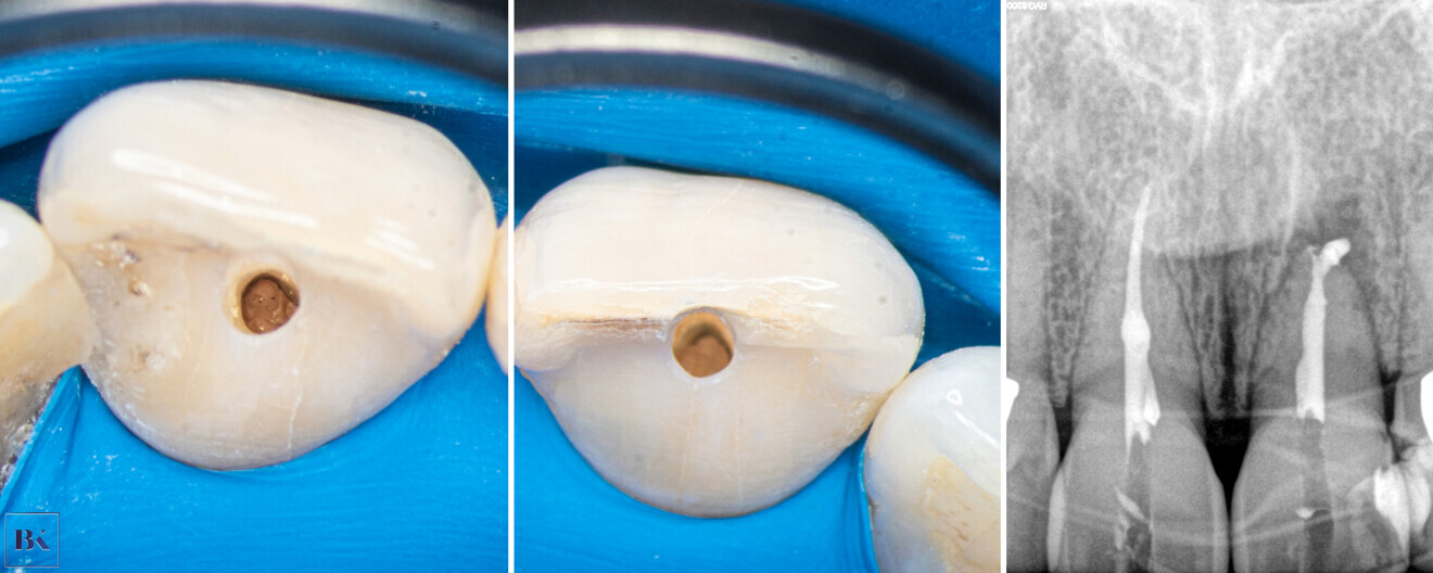 Figs. 20a–c: Obturation with gutta-percha (a & b) and the control radiograph (c).