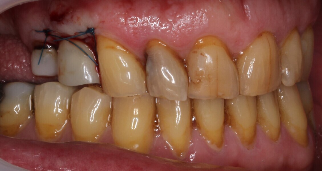 Fig. 18: Post-op situation.