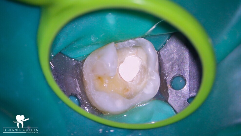 Fig. 5: Placing of CeraPutty (Meta Biomed) at the level of the exposed pulp.