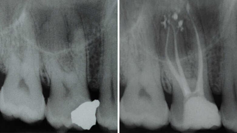 Vyplachování zahnutých kanálků