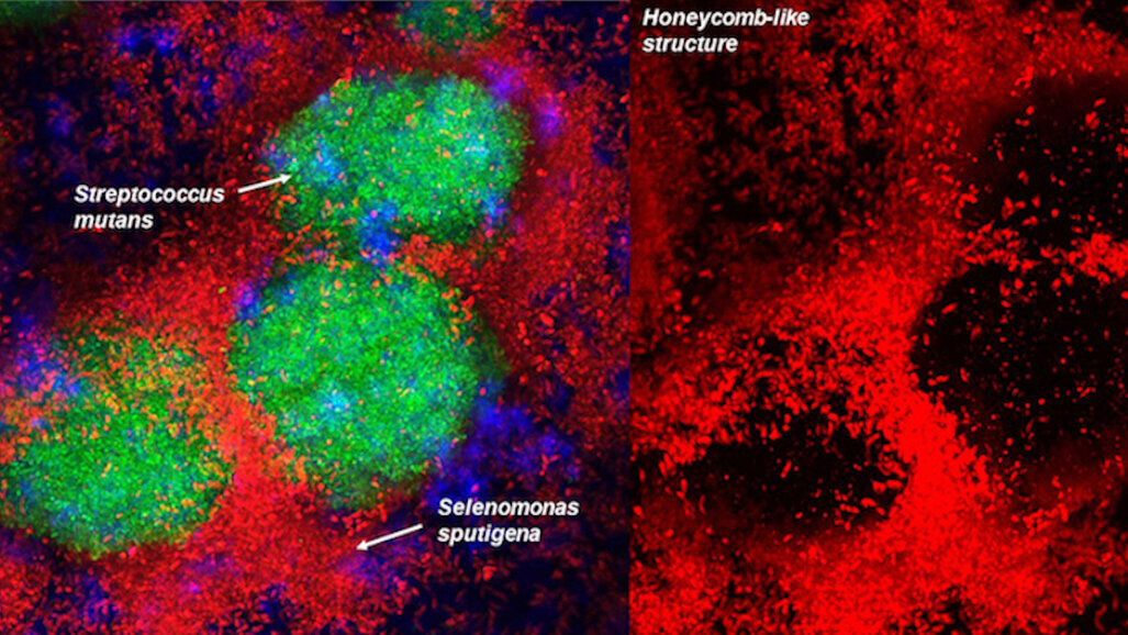Diş Çürüklerinde Etkili Yeni Bir Bakteri Keşfedildi