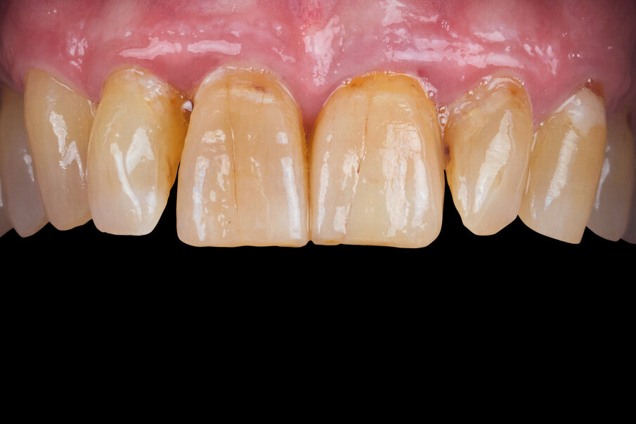 Fig. 9: Result: The patient is very satisfied with the final esthetic result.