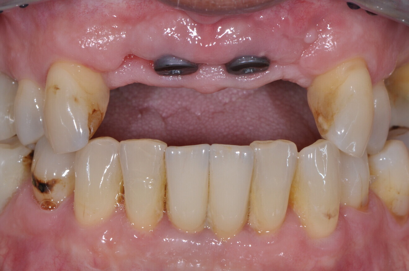 Figs. 13a & b: Intra-oral view of the implants with healing abutments after placement