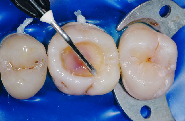 Fig. 23: Une fine couche de composite fluide est appliquée en fond de la cavité et est polymérisée. Cette couche initiale permet une diminution du stress de contraction de 20 a 50 % du composite de restauration. 
