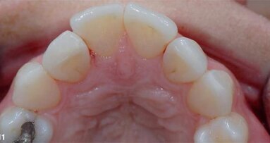 Non-invasive mini porcelain veneers: An alternative to direct resin restorations
