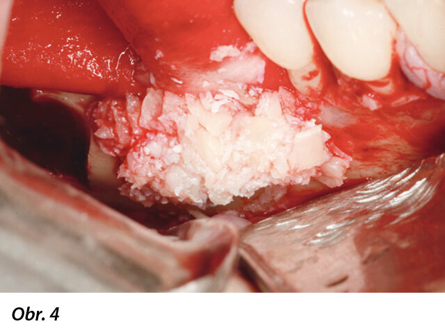 Bukální pohled po umístění směsi autogenní granulované kosti a granulí Geistlich Bio-Oss v poměru 1 : 1. Všimněte si, že membrána Geistlich Bio-Gide je před umístěním štěpu fixována na hřebeni.