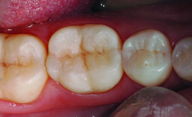 Fig. 32 : Vue occlusale. 46 possède une restauration composite occlusale réalisée il y 6 jours. Cette dent présente des
phénomènes de sensibilités post-opératoires.