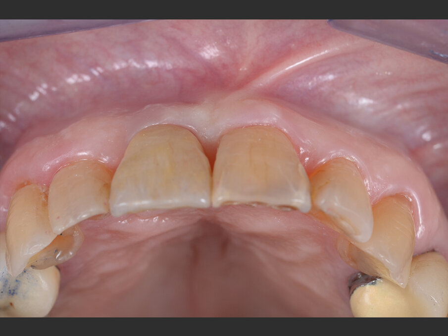 Fig. 12 - Valutazione post-operatoria: riabilitazione definitiva in situ in visione occlusale.