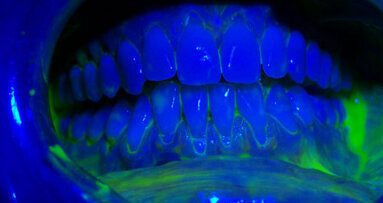 Il management di igiene orale e cosmesi in presenza di recessioni e abfrazioni: case report